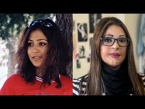 ആത്മവിശ്വാസത്തിന്റെ  ഉയര്‍ത്തെഴുന്നേല്‍പ്പിന്റെ വിജയം- ആസിഡ് അറ്റാക്ക് ഇരയുടെ ജീവിതം